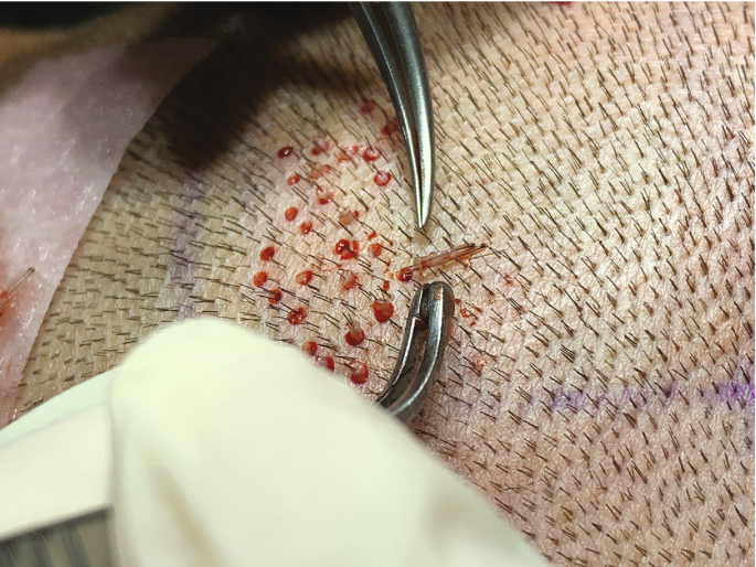Irregular tissue removed by 5 mm punch tool after dermal piercing