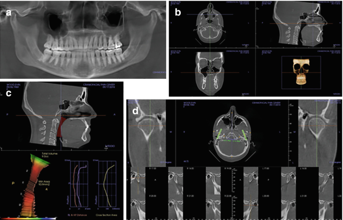 4 scan images. A. Image of the nostrils and jaws revealing teeth. B. Image of the buccal cavity, with lateral view of the airway to the right and image of a human skull below. C. Lateral view of the head, with inflammation present in the airway. D. Multiple C T images with bilateral T M condyles bent backward.