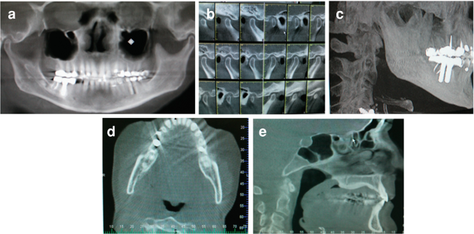 5 scan images. A. A lower portion of the skull with teeth. The teeth on either side of the jaw have a lighter shade. B. C T images of the temporal fossa, with lower jaw bent inwards. C. Lateral view of the lower jaw, with no neck curvature. D. Image of the airway with mouth open revealing the teeth. E. Narrowed oropharyngeal airway.