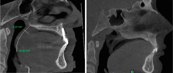 Two sagittal perspectives of cone-beam computed tomography of the nasal cavity with the left image with lines labeled 12.29 millimeters and 49.38 millimeters. In the right image a particular region is labeled as B.