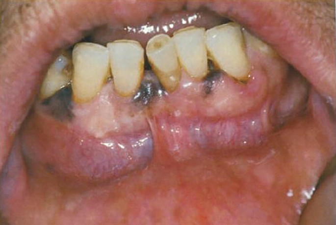 Ch22: Pigmentations of the Oral Mucosa and Facial Skin