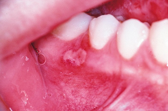 aphthous ulcers