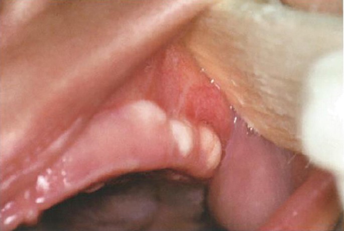 melanotic stools or melenic stools Melena: Symptoms, Causes, Diagnosis, Treatment and Cost