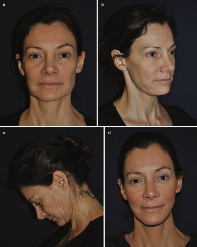 Stem Cell-Enriched Fat Injection in Aesthetic, Reconstructive