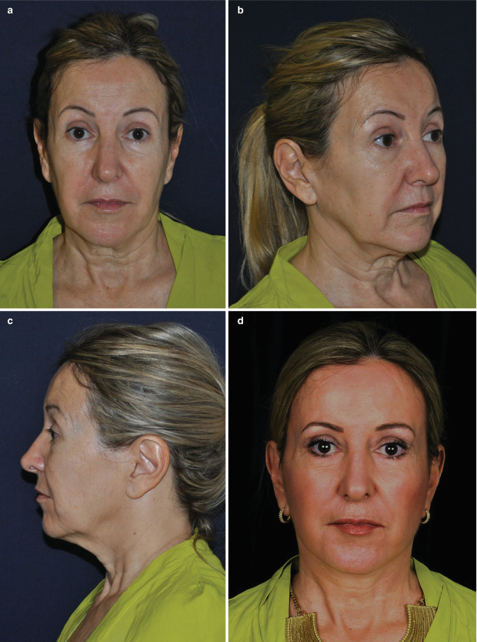 6 photographs for the front, side, and lateral views of the face. A to C are pre-operative images with visible asymmetrical facial features and necklines. D to F has comparatively lifted facial features with symmetrical necklines.