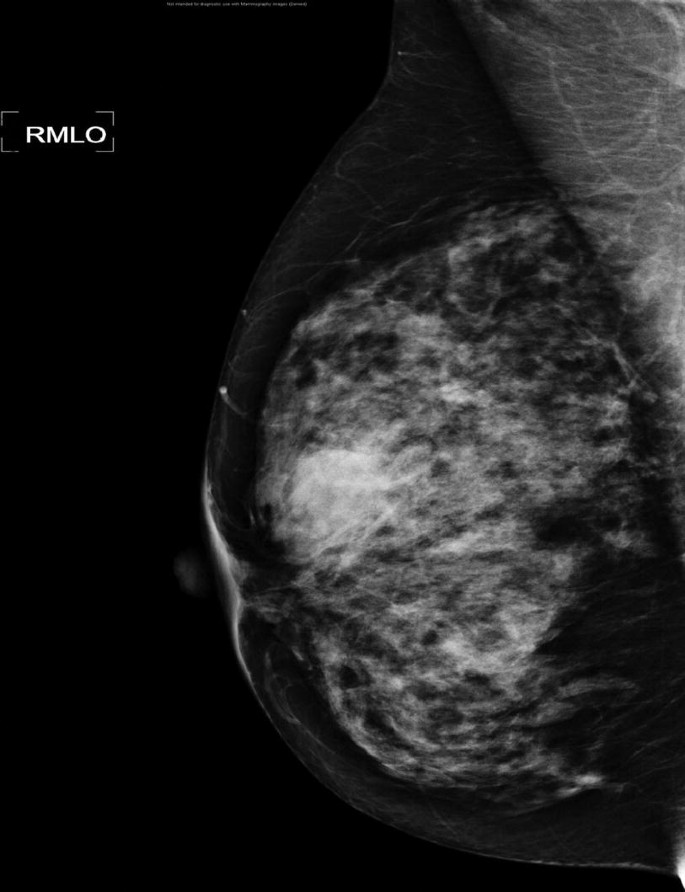 Breast Density and Influencing Factors