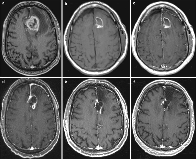 Six axial sections of the brain with bright margin and hemorrhage in initial 3 M R I images. The mass can be seen decreasing in the follow-up scans of the patient.