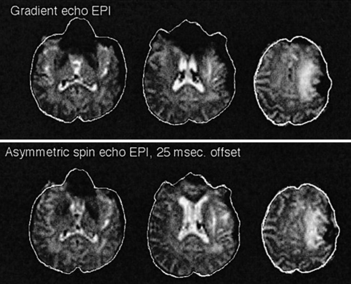 A set of 6 M R I scans. On the top are gradient echo E P I and on the bottom are asymmetric spin echo E P I.