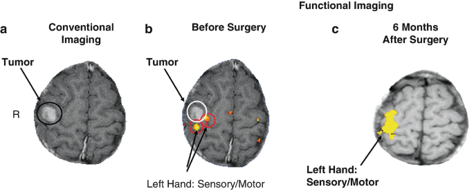 Three-part illustrations of the brain for conventional imaging, before surgery, and 6 months after surgery. The tumor is marked on the left side of each.