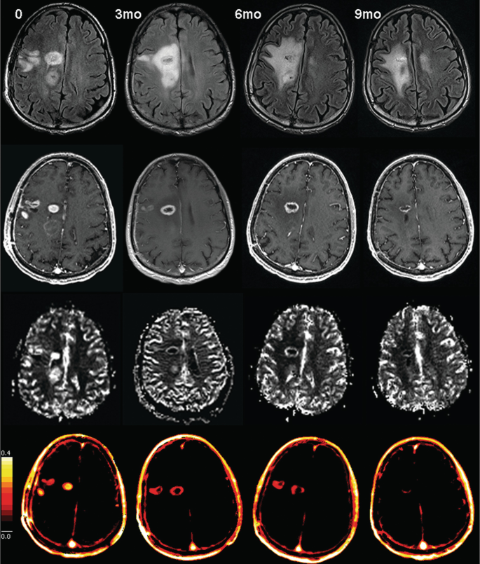 A set of 4 M R Is of the axial sections of the brain with a tumor on the right side were taken after 0, 3, 6, and 9 months and its progression is noted.