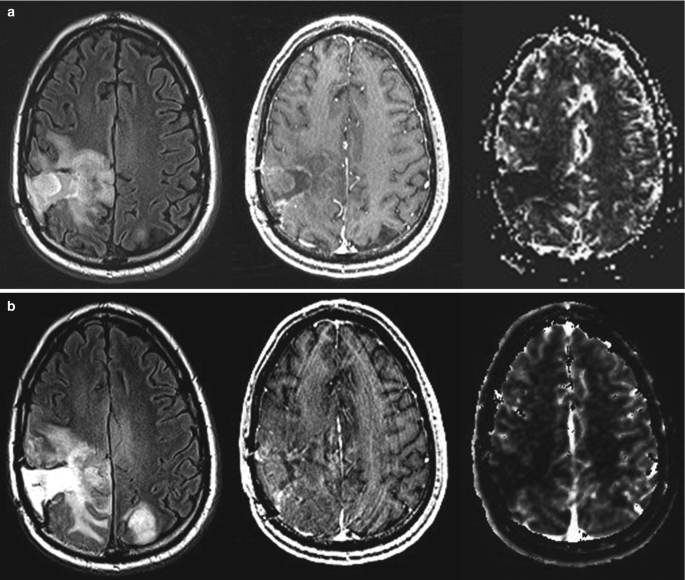 Two sets of M R I, a and b, of the axial slices of the brain with bright density on the right hemisphere of the cerebral cortex. The second image in A is the brightest of all.