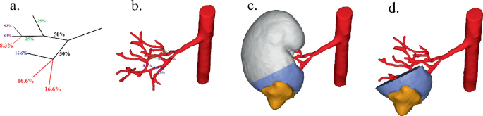 4 diagrams. A has the percentages over branches, b is the same along blood vessels, c is a base of kidney shaded and a mass bulging, and d is a cut base.