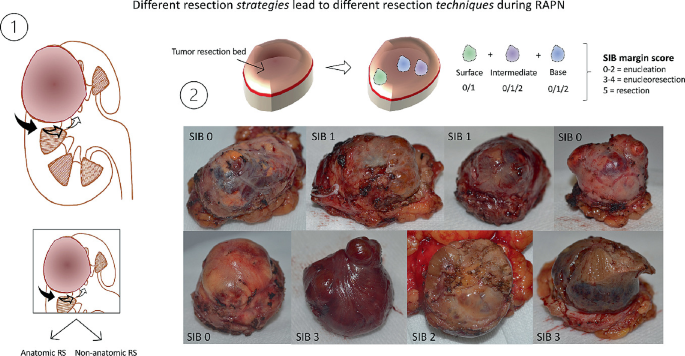 Two illustrations of different resection strategies leading to different resection techniques during R A P N. 1 is the kidney while 2 is the resection bed labeled with surface, intermediate, and base. 8 snapshots below are the resected samples scored 0 to 5 based on enucleation, enucleoresection, and resection.