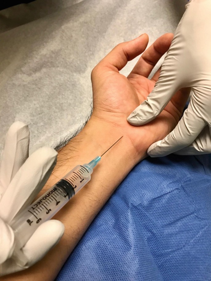 Carpal and Cubital Tunnel Injections