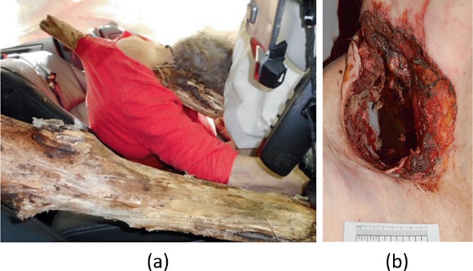 A pair of images represents lethal penetrating blunt force trauma caused due to a falling branch.