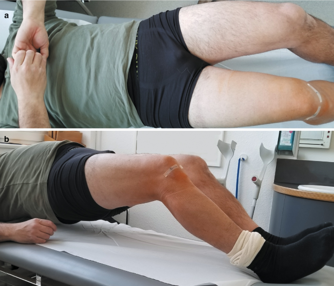 Rehabilitation After ACL Reconstruction, Return to Sport and Prevention