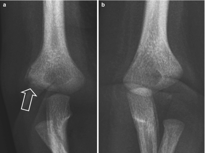 Two x-rays of the arm of an infant. a. An arrow indicates the fracture in the metaphysis of the distal humerus. b. A light-shaded patchy region indicates the healed crack of the proximal ulna.