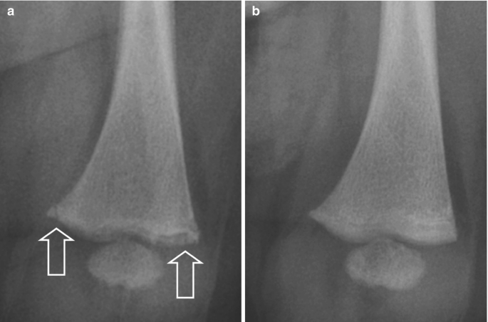 Two x-rays of the leg. a. Two arrows indicate the fracture at the distal femur metaphysics. b There is no fracture in the femur.