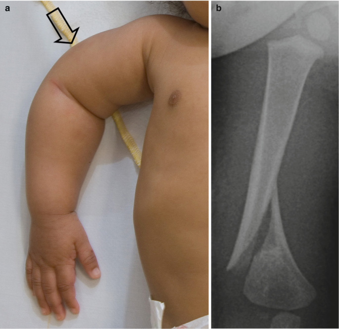 a. A photograph of the shoulder of a newborn baby with a bow-shaped arm. b. A radiograph of the shoulder of an infant. There is an oblique bone break at the lower humerus.