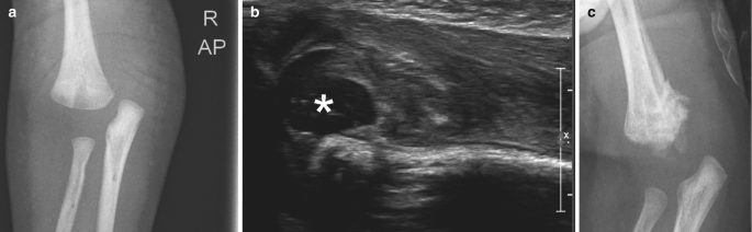 a. A radiograph depicts the abnormal arrangement of the bone at the elbow joint. b. An ultrasound with an asterisk indicates an oval, dark spot at the elbow joint. c. A radiograph depicts the bone development at the lower humerus.