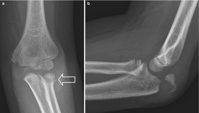 Two radiographs of the elbow of a patient. a. An arrow indicates a fracture at the radial head. b. There is a fracture at the curved end of the radius.