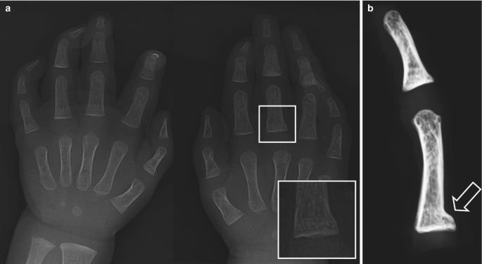 Two radiographs. a. On a radiograph of both hands, two rectangular boxes present a magnified view of the fracture at the proximal phalanx of the middle finger. b. On a finger radiograph, an arrow indicates an edge at the lower end of the bone.