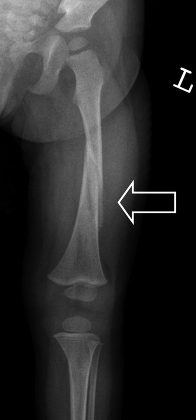 A radiograph of the left leg of a boy. An arrow indicates a fracture at the femoral shaft.