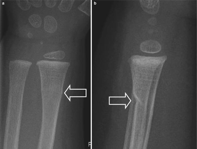 Two x-rays of the arm. a. An arrow indicates the deformation at the outer surface of the distal radius. b. an arrow indicates the torus fracture of the bone.