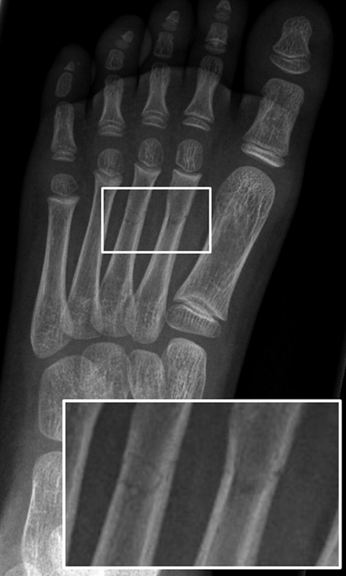 A radiograph of the foot of a child. Two rectangular boxes present a magnified view of the fractures in the 2 and 3 metatarsals.