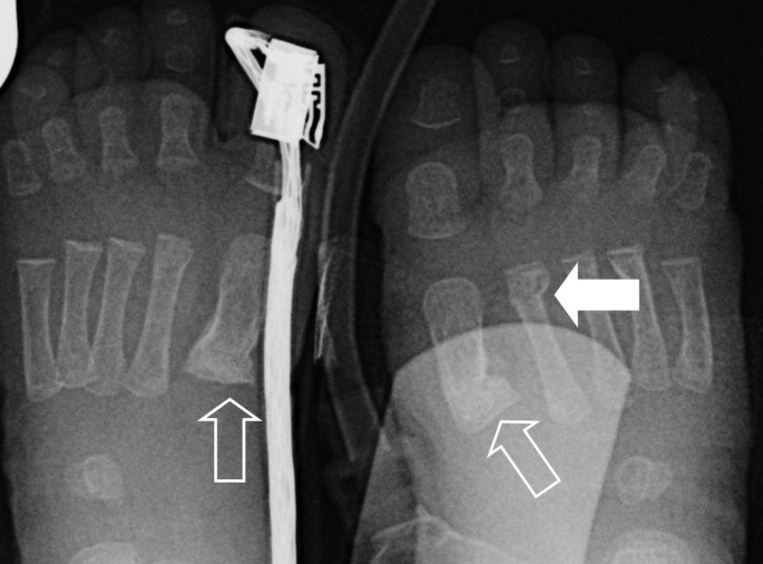 A radiograph of the feet of a child. Three arrows indicate the fracture at metatarsal 1 of the leg foot and a fracture at metatarsal 1 and 2 of the right foot.