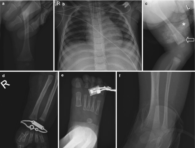 8 radiographs of the femur, chest, legs of baby, radius bone, right foot, tibia and fibula, chest region, and left hand. All radiographs depict obstruction due to different materials such as hands, tubes, diaper, bracket, oximeter, bandage, metal studs, and clothing.