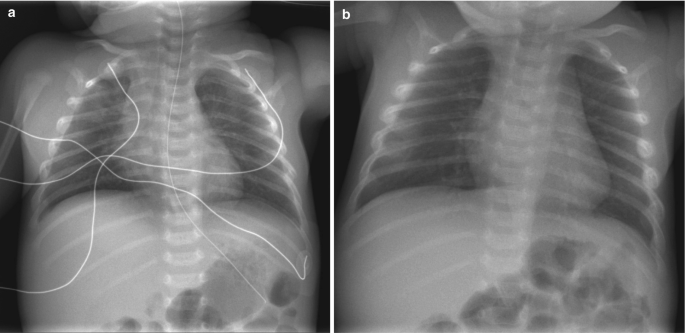 2 radiographs of the front view of the chest. a. The membrane lining the lungs appears thick on the right side. A fracture at the sixth rib on the left lateral side. b. Bright appearance at third to sixth and fourth to seventh ribs on right and left lateral sides.