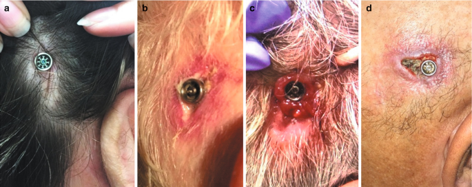 4 photos of the right ear with the percutaneous osseointegrated device. A, depicts percutaneous abutment in a healthy appearance. B, depicts erythema and moisture around the abutment. C, depicts the granulation tissue. D, depicts the breakdown of the wound and granulation tissue.