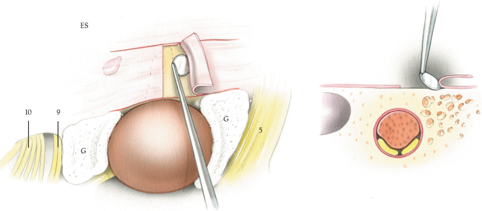 2 illustrations of surgical management during an I A C portion of the tumor. It depicts the anterior and posterior elevation of dural flaps. The highlighted parts are the vagus nerve, glossopharyngeal nerve, endolymphatic sac, Gelfoam, and trigeminal nerve.