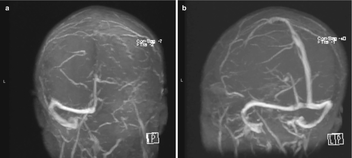 2 M R V images A and B depict after resection of a right sided vestibular schwannoma and a follow up after 1 year indicates a normal flow in the dural venous sinus system respectively.