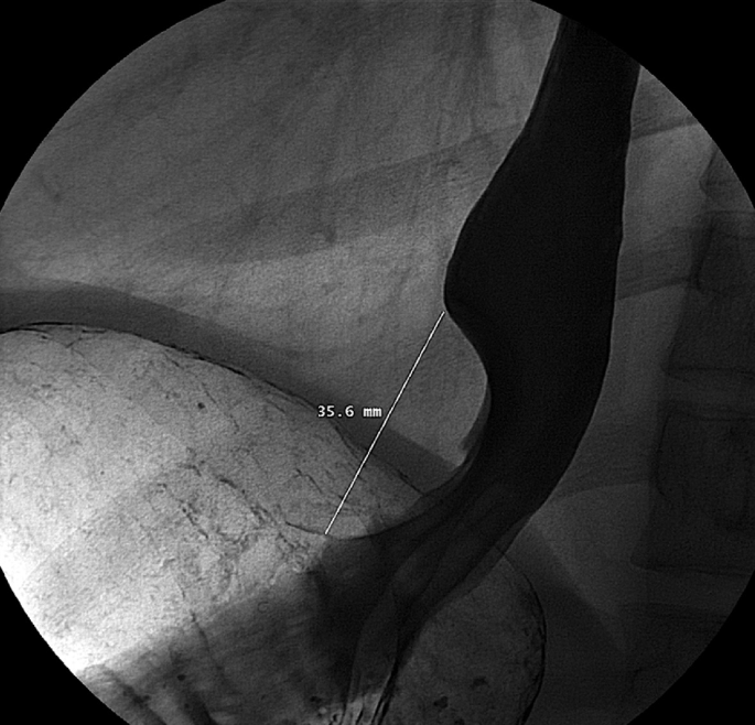 A radiological evolution represents the zoomed esophageal leiomyoma of the patients with a barium swallow.