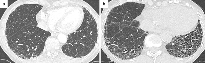 Two scanned images of the lungs. a, the scan presents the lungs, and b, the scan presents the narrowed left side of the lung.