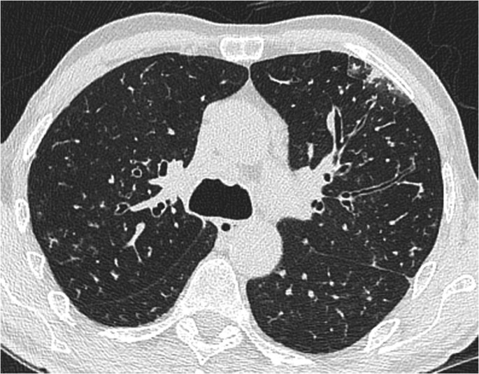 An axial C T scan of the chest illustrates the lungs. The upper left lobe illustrates cloudy regions with mild alveolar consolidation in the pleural areas. The lungs also illustrate central bronchiectasis upper left lobe.