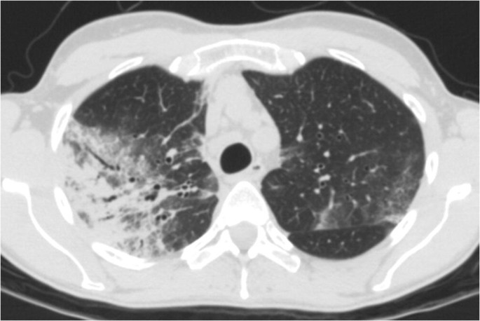 An axial C T scan of the chest region illustrates the lungs. The left and right lungs have light colored opacities and ground glass opacities. The opacities are more dominant in the right lung.