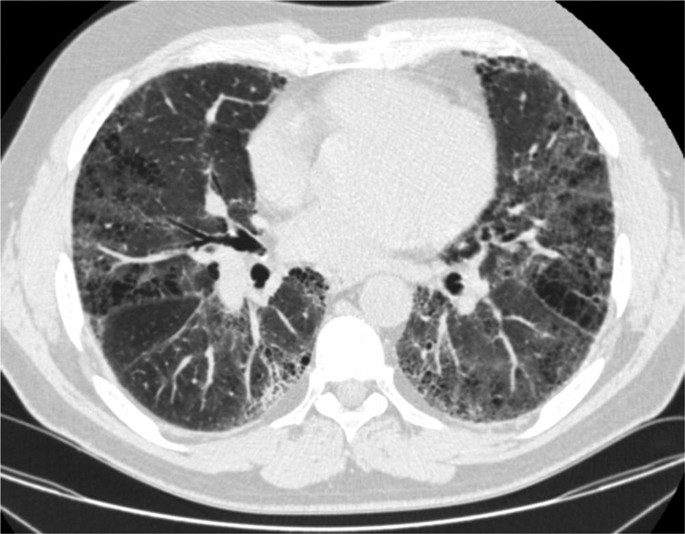 An axial C T scan of the chest illustrates the lungs. The lungs have patches in the shape of ground glass calcifications. The lung region also illustrates dark patches. The walls also appear thickened.