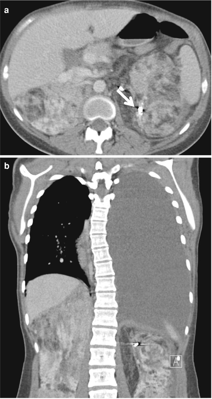 2 C T scans illustrate the abdominal region of a patient. The scans illustrate an axial and coronal view. The kidney is marked with an arrow in scan A. Scan B illustrates an empty spot in the right to the upper part of the abdomen.