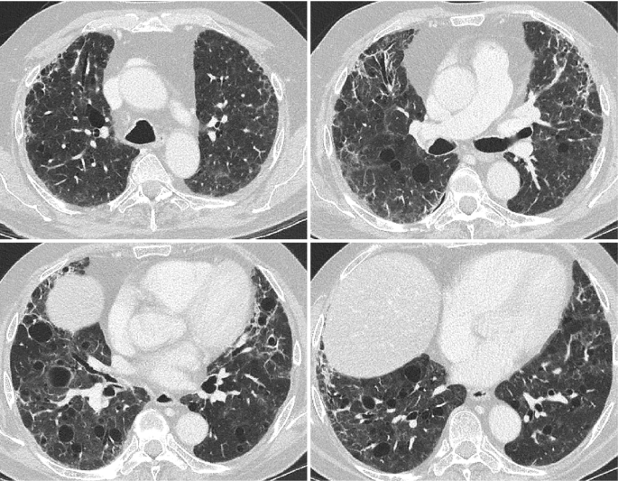 4 chest C T scans. Small cysts in the lung tissue are surrounded by a thin wall. Cysts are observed in the outer edges of the lungs. A pattern of fine fiber lines and widening of the airways with peri broncho vascular extension is observed.