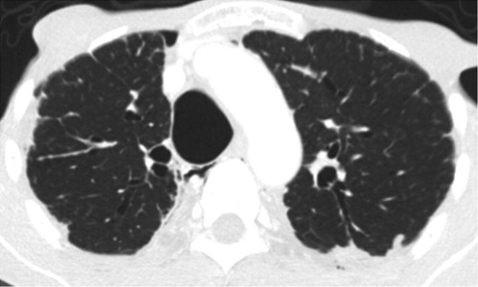 A C T scan of the chest highlights right and left lungs with an expanded trachea.