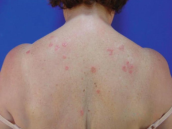 A photograph of a person's back with granuloma annulare. Red annular plaques scattered across the back area are observed.