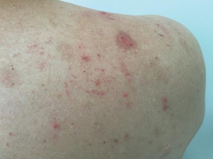 A photograph of a patient's back with subacute prurigo. Flares and papules are observed.