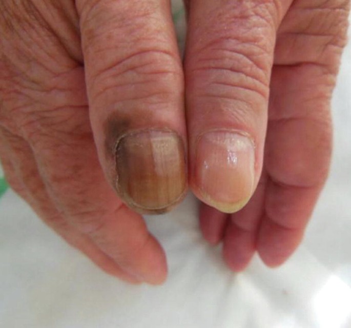 Nail disorders in children - Know the types and causes