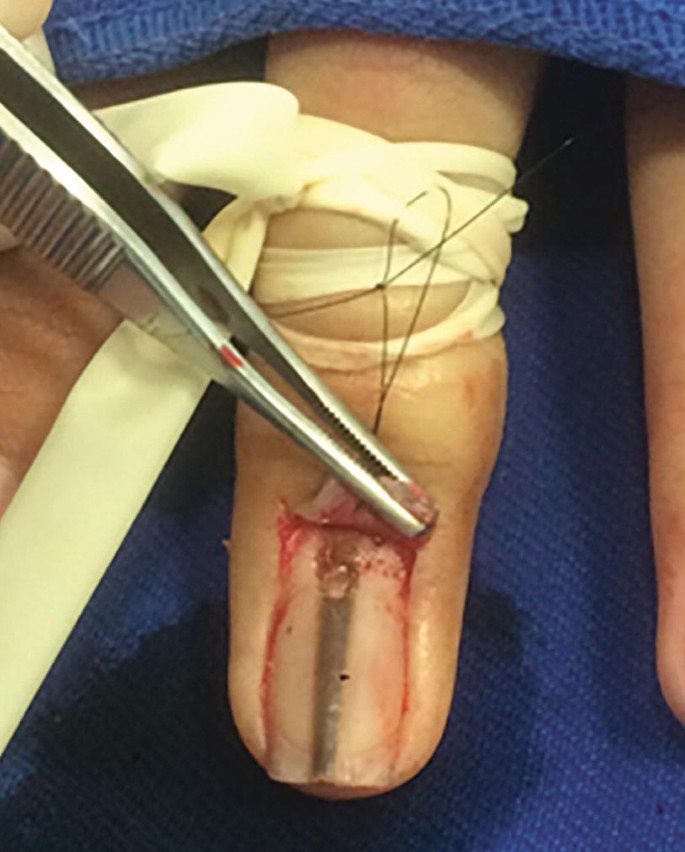 A photograph represents a human finger, where the nail is operated by an instrument named an incision.