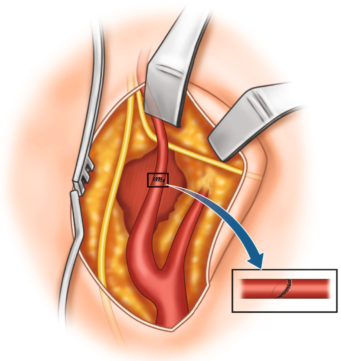 An illustration of a surgical opening of the thorax. The region of the artery affected by the aneurysm is removed and ligated.