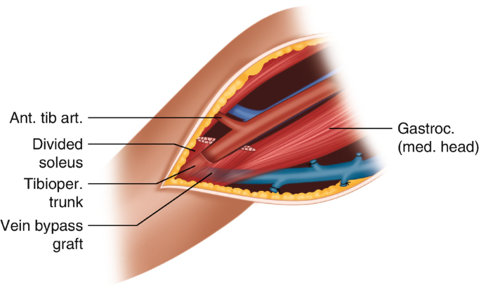 A diagram of a surgical incision made on the knee joint. The muscles present inside are the Divided soleus, Tibioper trunk, and Gastroc. A grafted bypass vein is present below the muscle, and an anterior tibial artery is also resent inside the incision.