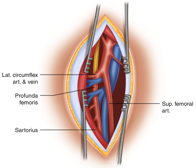 A diagram of the anatomy of the internal structures present within the femoral sheath. The region consists of branches of the lateral circumflex artery and vein, superior femoral artery, profunda femoris muscle, and sartorius muscle.